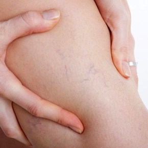 1 de cada 4 personas muere por&nbsp;trombosis